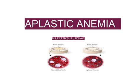 Aplastic Anemia Pptx