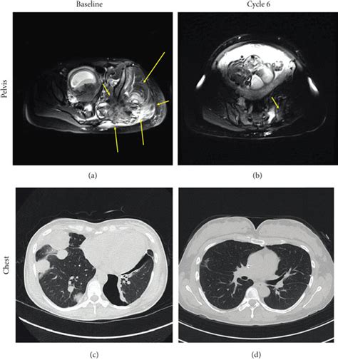 Computed Tomography Scans Of A B Pelvis And C D Chest For Case 3