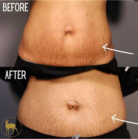 Stretchmarks Solutions Lexington Ky Jazzi Cosmetic Surgery