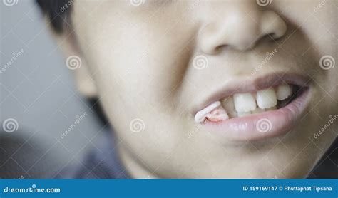 Close Up Of Boy Mouth Biting The Gauze In Mouth After Tooth Extraction