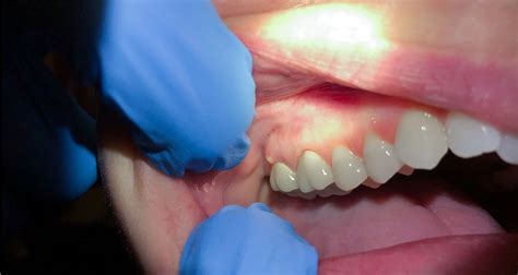 10 Common Symptoms Of Tooth Infection Spreading To Body