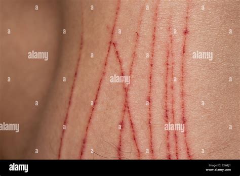 Painful Surface Skin Injury Bleeding Scratches On Human Male Body
