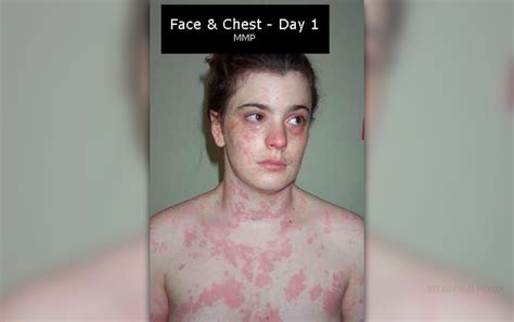 Chronic Hives And Other Hives Complications Everyday