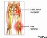 Pictures of Sciatic Nerve Damage Treatment Options
