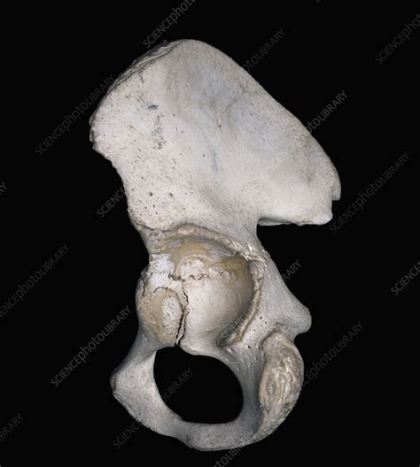 Lateral Surface Of Hip Bone Stock Image C0127042 Science Photo