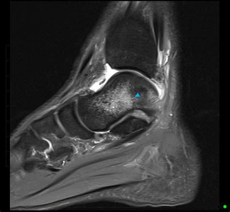 The purpose of this study was to investigate the relationship of muscle mri findings and gait all dm1 patients presenting with foot drop showed high intensity signals in the tibialis anterior muscles on. MRI of Sports Injuries - Musculoskeletal MRI