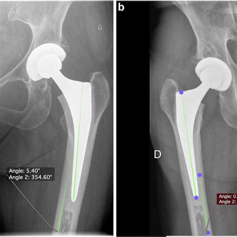A Immediate Postoperative Right Anteroposterior Hip Radiographs With