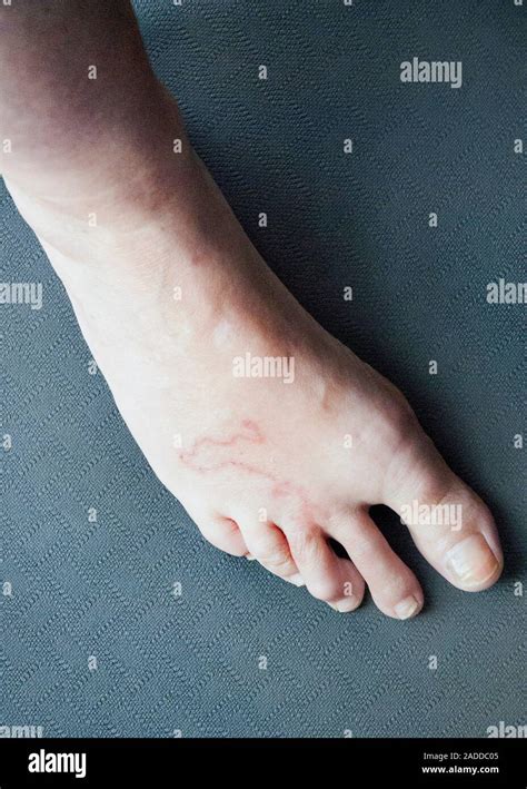 Cutaneous Larva Migrans Infection Foot Of A Patient With Cutaneous
