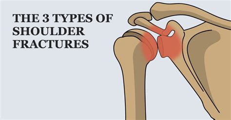Types Of Shoulder Fractures Welcome To Sys Medtech International Pvt