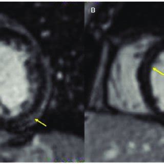 Short Axis Phase Sensitive Inversion Recovery Late Gadolinium Enhanced