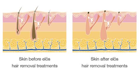 Laser Hair Removal Treatment At Faces Med Spa In Maryland