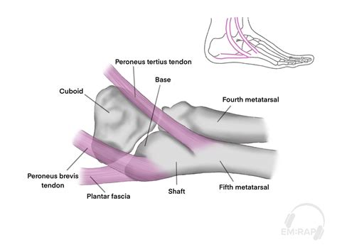 Case Report Fifth Metatarsal Fracture Sports Medicine Review