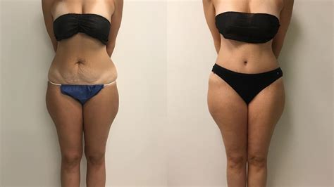 Tummy Tuck 360 Before And After Pictures Case 202 Barrington