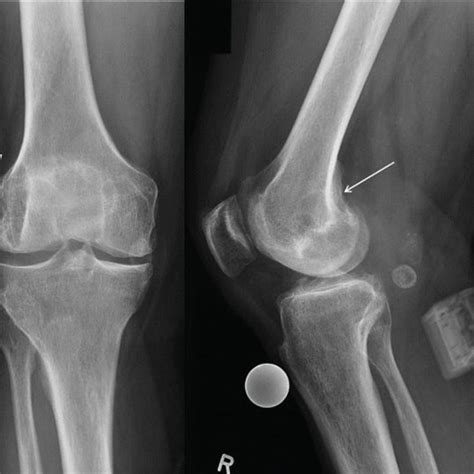 Postoperative Radiographs Of The Right Knee Confirmed The Correct