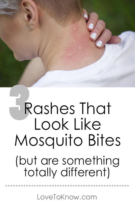 Rash That Looks Like Mosquito Bites Skin Rashes Pictures Common Skin