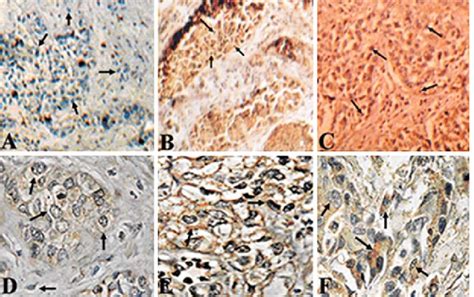 Immunohistochemistry Of P16 And Sh3gl2 A C P16 Staining Pattern And