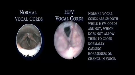 Vocal Cord Papilloma Symptoms And Effective Treatment Methods — Papillomas