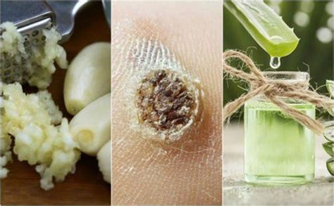 5 Home Remedies To Remove Warts Naturally Daily Health Valley