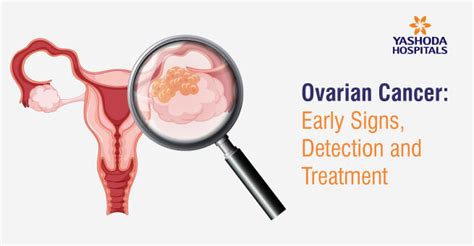 Ovarian Cancer Early Signs Detection And Treatment