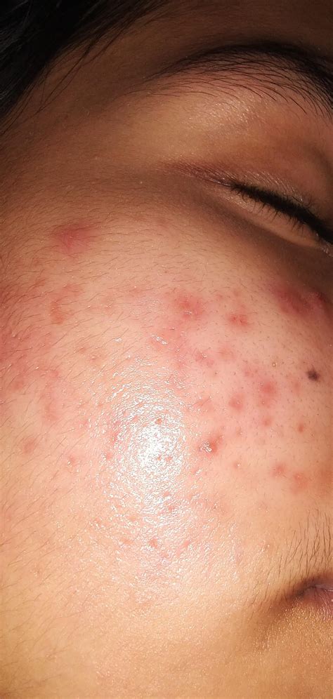 Tretinoin005 Made My Mild Acne Go Crazy 4 Months In Active Acne Is