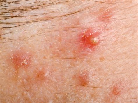 Pin On Bumps Pimples Acne Zits Scabs And Sores