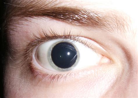 les pupilles de lenfant sont dilatees les raisons pour lesquelles les pupilles sont toujours