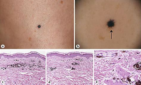 Clinical Appearance Of An Asymptomatic Blue Blackish Plaque 2 Mm In