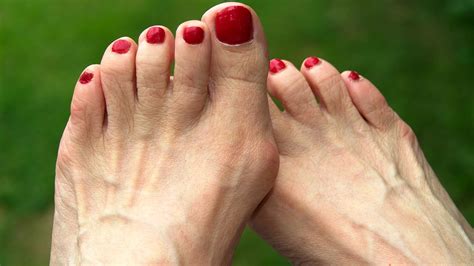 What To Do If You Have A Bunion Ohio State Medical Center