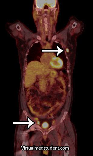 Hodgkins Lymphoma