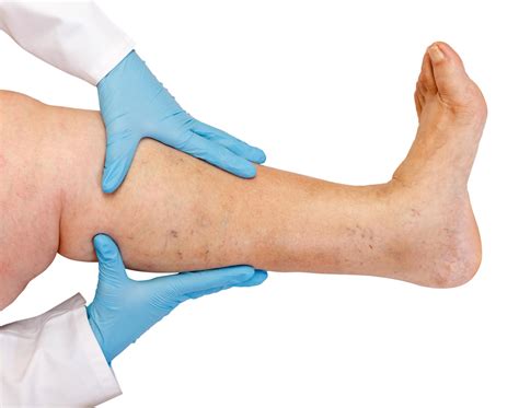 Venous Insufficiency and Wounds | Great Neck Family Foot Care