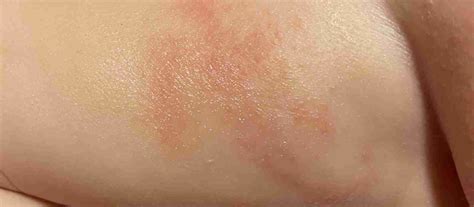 What Is Diaper Rash Symptoms Treatment And Tips To Prevent Raising