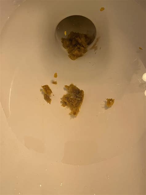 Please Help Me This Is What My Poop Looks Like 247 Its Never Firm