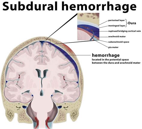 Subdural Vs Epidural Hematoma Symptoms