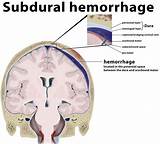 Spinal subdural or epidural hematoma. Epidural hematoma causes, signs, symptoms, diagnosis ...