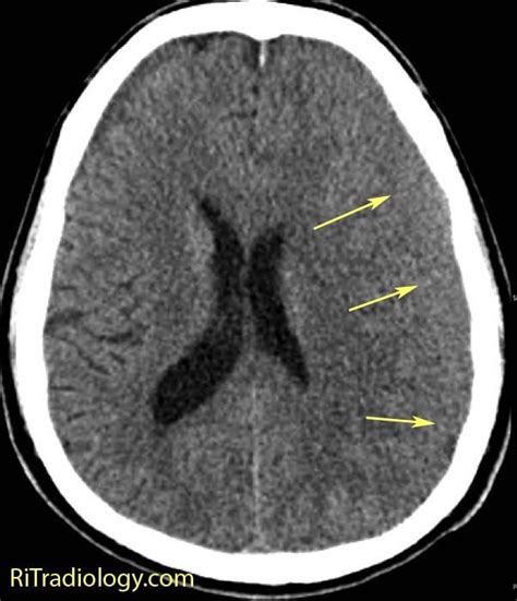 Rit Radiology Acute Isodense Subdural Hematoma