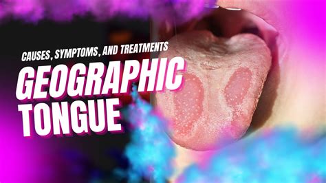 Understanding Geographic Tongue Causes Symptoms And Treatments