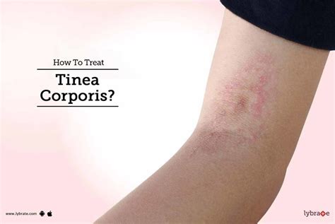 How To Treat Tinea Corporis By Dr Rahul Balmiki Lybrate