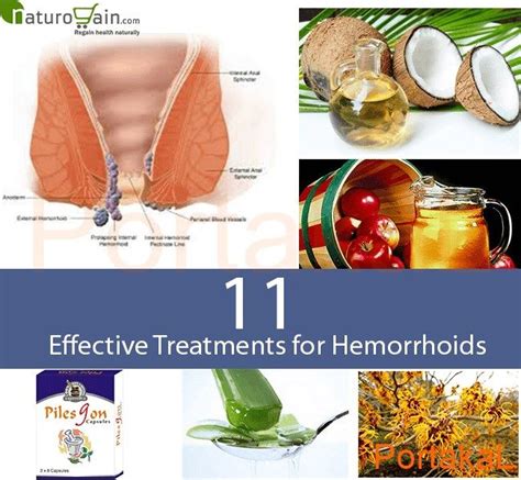 15 Natural Remedies In 2020 Hemorrhoids Natural Headache Remedies
