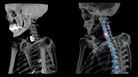 Improve Diagnostic Accuracy With Xspect Bone Spectct Siemens