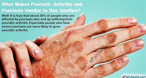 How Is Psoriatic Arthritis Connected With Psoriasis