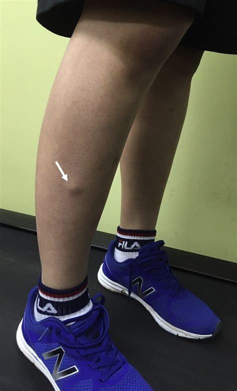 Young Woman With Leg Mass Annals Of Emergency Medicine