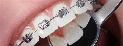 Ortodontia O Que é Para Que Serve E Seus Benefícios Sorria Vitta