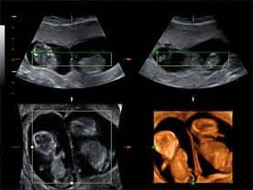 ecografia  el diagnostico del embarazo gemelar