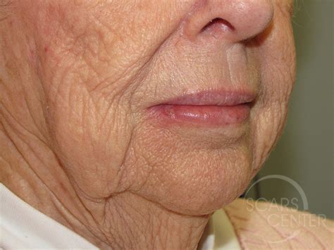 Lip Reconstruction 1 Skin Cancer And Reconstructive Surgery Center