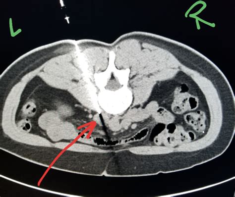 Lymph Node Ct Scan Contrast