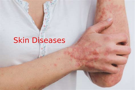 What Is Skin Diseases Summary Skin Disease Types And More
