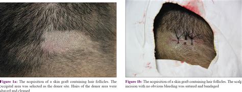 Experimental Study And Clinical Observations Of Autologous Hair