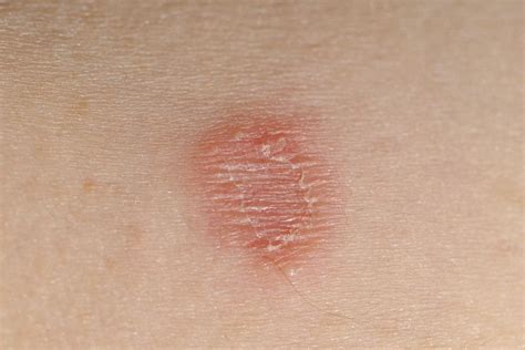 Jak wyglądają typowe infekcje skóry Medycyna