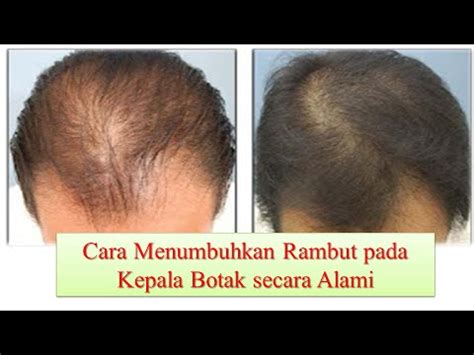 Cara Menumbuhkan Rambut di Kepala Botak Secara Alami - YouTube