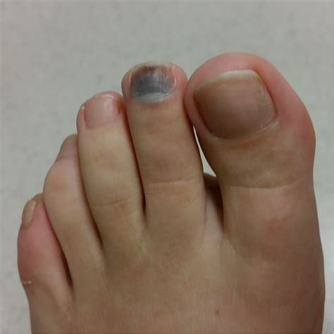 Black Toenail Treatment Causes And Prevention